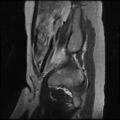 Normal female pelvis MRI (retroverted uterus) (Radiopaedia 61832-69933 Sagittal T2 5).jpg