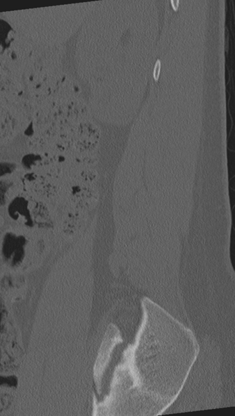 File:Normal lumbar spine CT (Radiopaedia 46533-50986 Sagittal bone window 90).png
