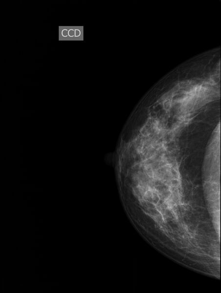 File:Normal mammogram radiographs (Radiopaedia 77107-89068 CC 1).jpg