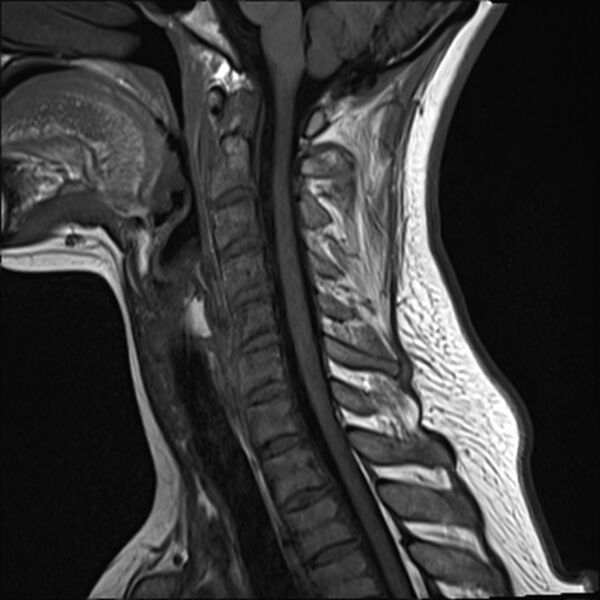 File:Normal trauma cervical spine MRI (Radiopaedia 32130-33071 Sagittal T1 9).jpg