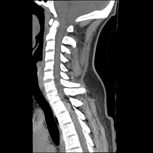 File:Normal trauma spine imaging (Radiopaedia 31753-32686 A 21).jpg
