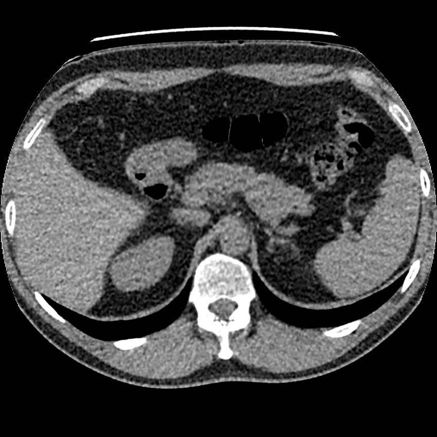 Obstructing ureteric calculus and ureteric anatomy (Radiopaedia 62730-71042 Axial non-contrast 10).jpg