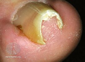 Pincer nail