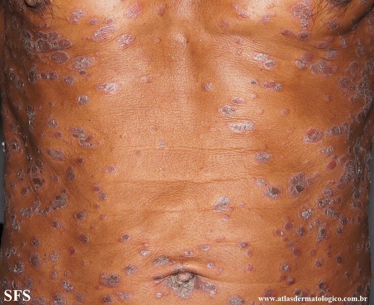 File:Psoriasis (Dermatology Atlas 135).jpg