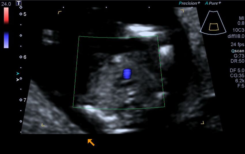 1st trimester nuchal-morphology ultrasound (Radiopaedia 44706-48477 Heart views cine with colour 140).jpg