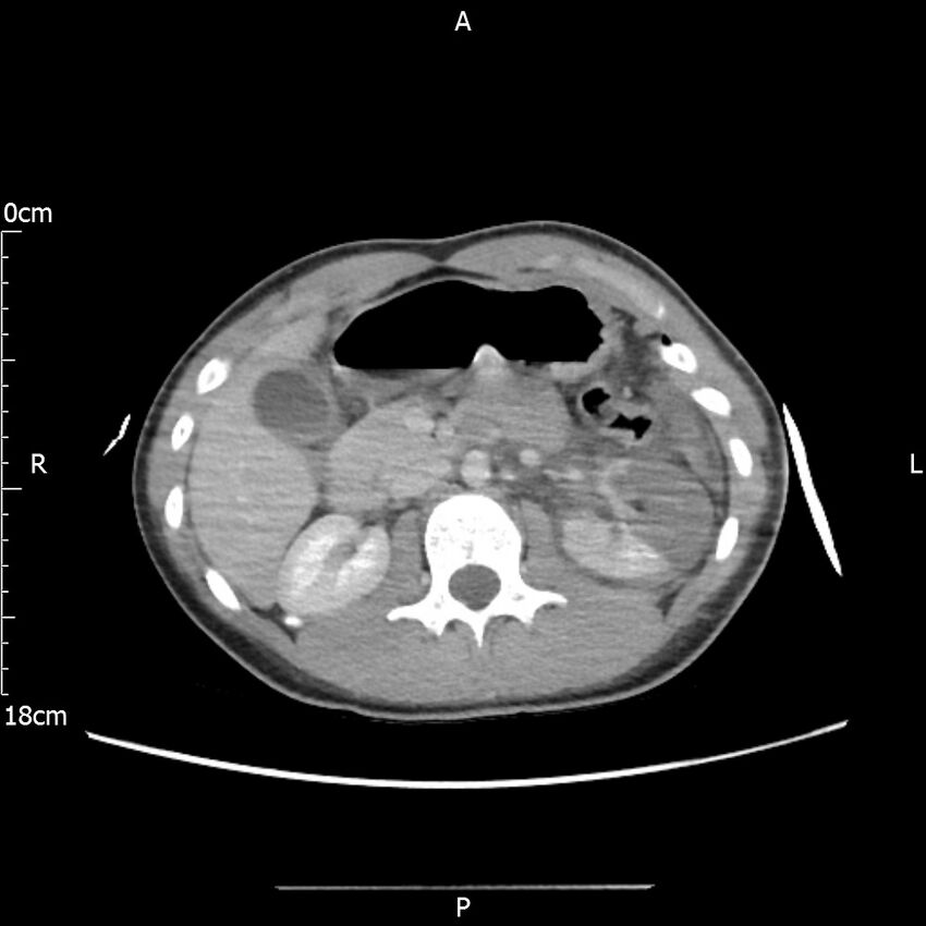 AAST grade IV kidney injury with CEUS follow-up (Radiopaedia 72353-82877 Axial C+ portal venous phase 26).jpg