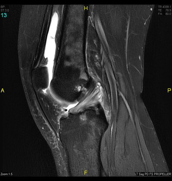 File:ACL mucoid degeration with cystic changes (Radiopaedia 48428-53341 Sagittal PD fat sat 11).jpg