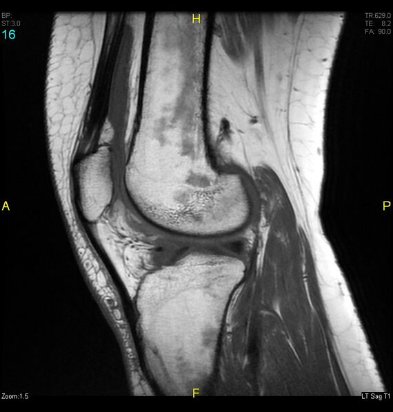File:ACL mucoid degeration with cystic changes (Radiopaedia 48428-53341 Sagittal T1 14).jpg
