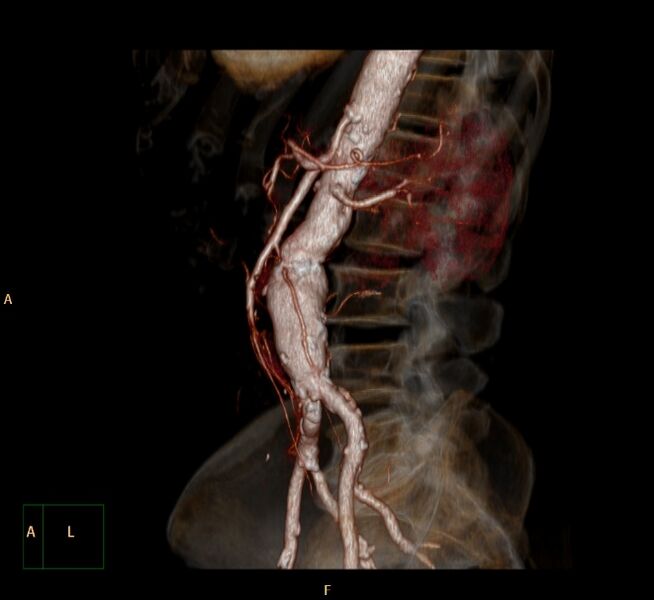 File:Abdominal aortic aneurysm (Radiopaedia 23703-23856 3D 21).jpg