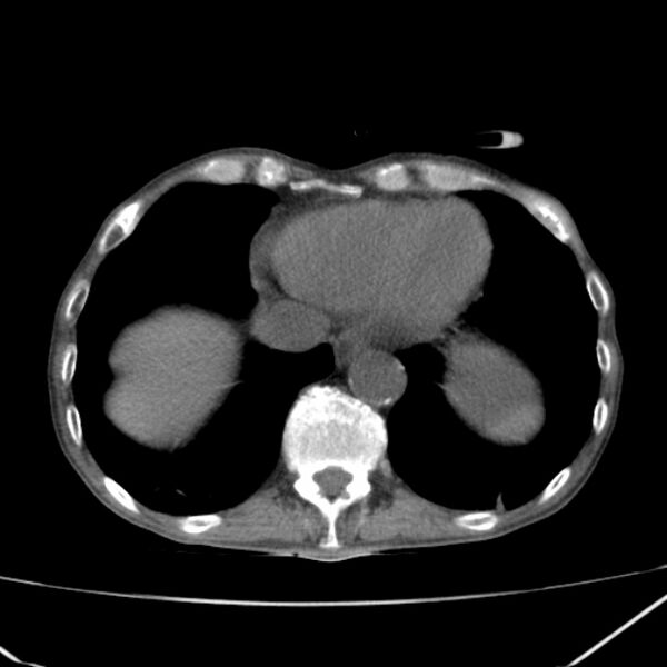 File:Abdominal aortic aneurysm (Radiopaedia 23703-23856 Axial non-contrast 4).jpg