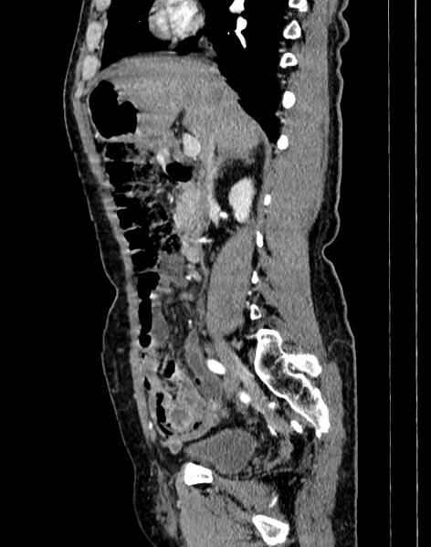 File:Abdominal aortic aneurysm (Radiopaedia 83581-98689 Sagittal C+ arterial phase 18).jpg