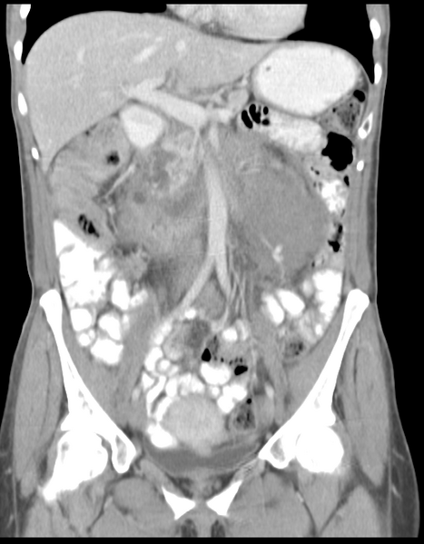 File:Abdominal desmoid tumor (Radiopaedia 41007-43740 Coronal C+ portal venous phase 18).png