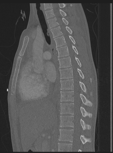 File:Abdominal multi-trauma - devascularised kidney and liver, spleen and pancreatic lacerations (Radiopaedia 34984-36486 Sagittal bone window 36).png