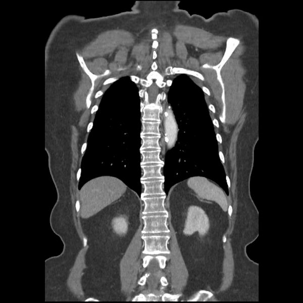 File:Aberrant right subclavian and left vertebral arteries (Radiopaedia 43467-46847 Coronal C+ portal venous phase 67).jpg