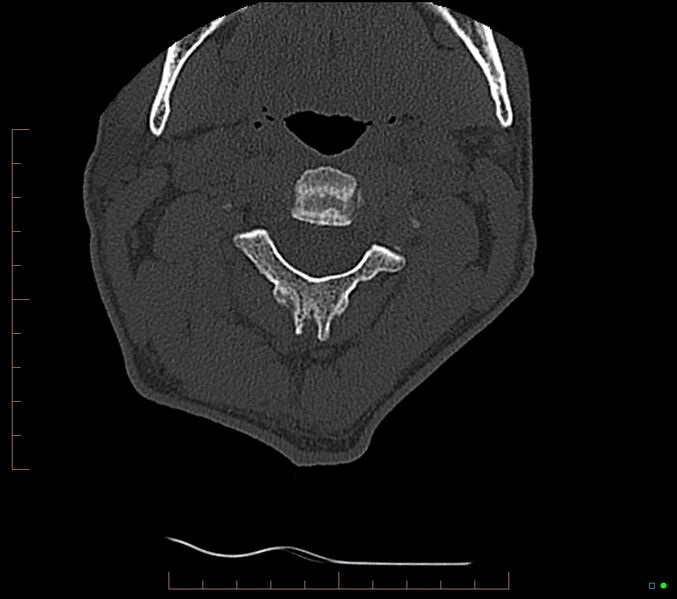 File:Accessory articulation of cervical transverse processes (Radiopaedia 82715-96933 Axial non-contrast 42).jpg