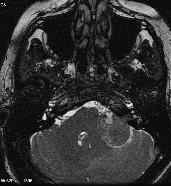 File:Acoustic schwannoma (large with cystic change) (Radiopaedia 5369-7130 Axial T2 2).jpg
