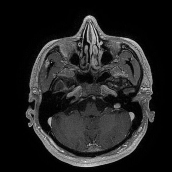 File:Acoustic schwannoma - intracanalicular (Radiopaedia 37247-39024 Axial T1 C+ 61).jpg