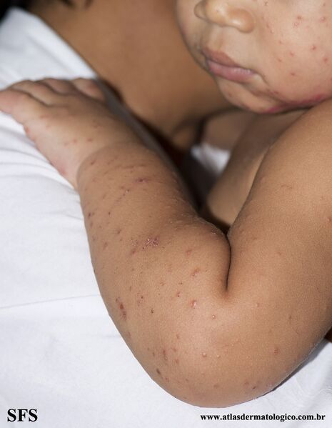 File:Acrodermatitis Infantile Papular (Dermatology Atlas 18).jpg