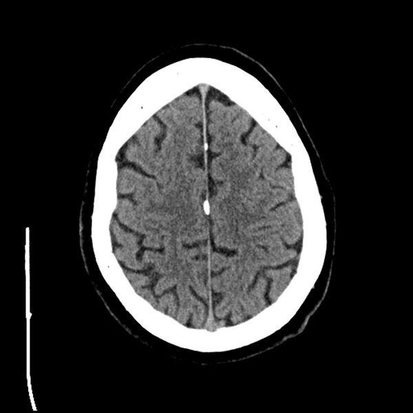 File:Acute A3 occlusion with ACA ischemic penumbra (CT perfusion) (Radiopaedia 72036-82525 Axial non-contrast 36).jpg