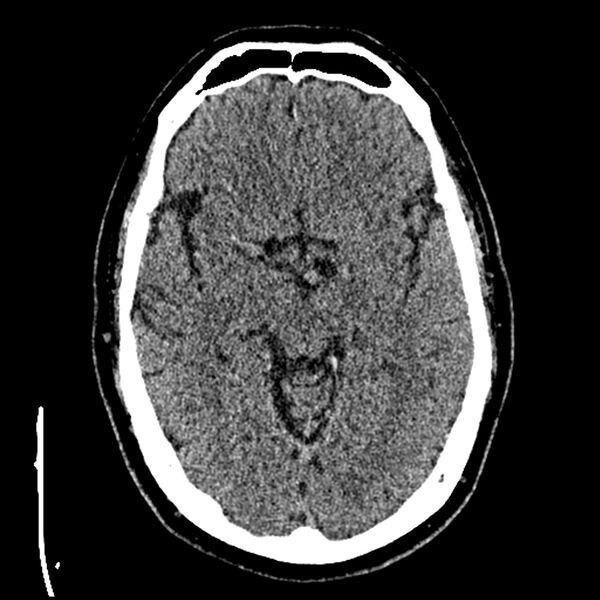 File:Acute A3 occlusion with ACA ischemic penumbra (CT perfusion) (Radiopaedia 72036-82525 Axial non-contrast thins 16).jpg