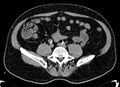 Acute appendicitis (Radiopaedia 13030-13091 Axial non-contrast 1).jpg