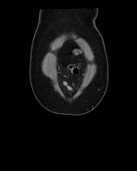 File:Acute appendicitis - large appendicoliths (Radiopaedia 61805-69820 Coronal C+ portal venous phase 14).jpg