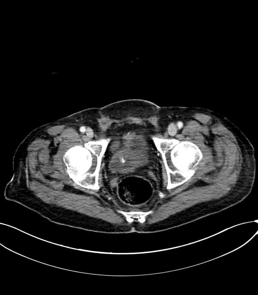 Acute arterial mesenteric ischemia (Radiopaedia 78238-90828 Axial C+ portal venous phase 132).jpg