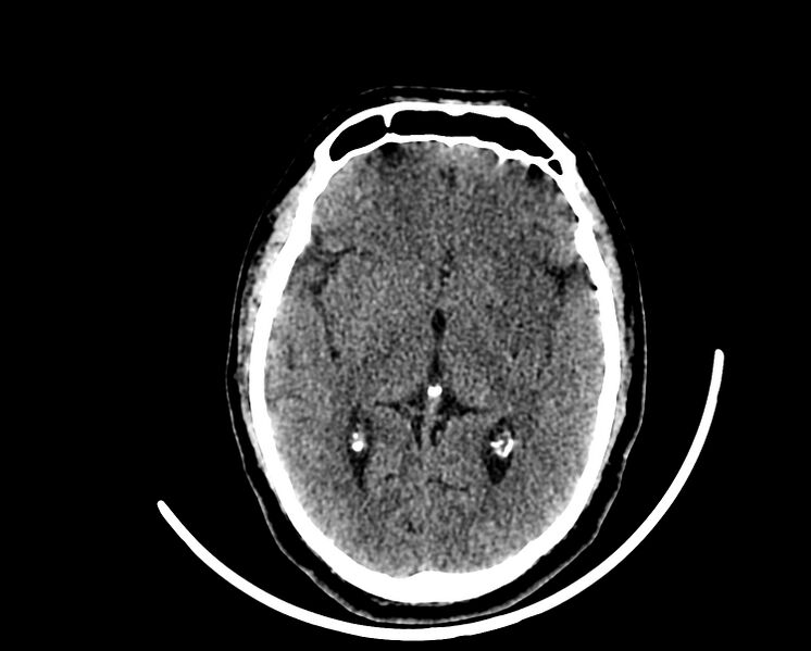File:Acute cerebral infarct (Radiopaedia 35604-37123 Axial non-contrast 49).jpg