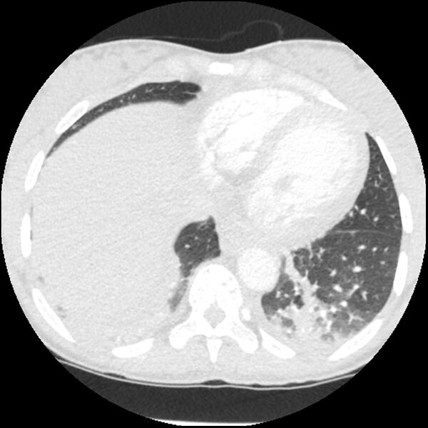 File:Acute chest syndrome - sickle cell disease (Radiopaedia 42375-45499 Axial lung window 149).jpg