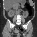 Acute cholecystitis and ureteric colic (Radiopaedia 42330-45444 Coronal prone 62).jpg