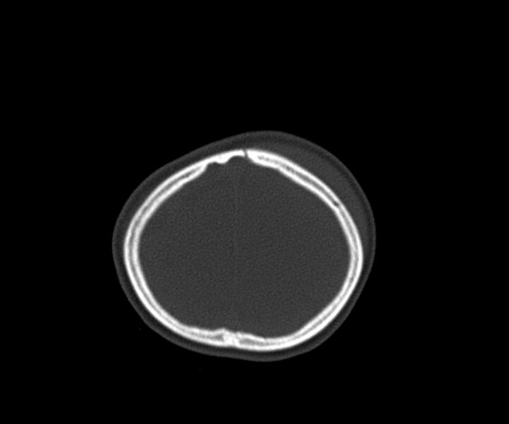 File:Acute epidural hematoma (Radiopaedia 63659-72335 Axial bone window 31).jpg