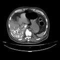 Acute heart failure (CT) (Radiopaedia 79835-93075 Axial C+ arterial phase 79).jpg