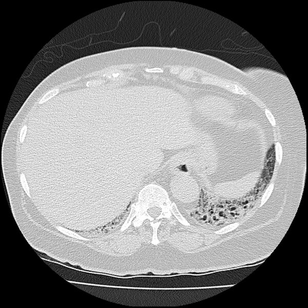 File:Acute interstitial pneumonitis (Radiopaedia 45404-49452 Axial lung window 79).jpg