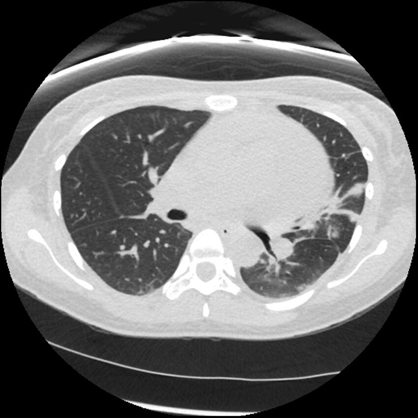 Acute lupus nephritis (Radiopaedia 45832-50107 Axial lung window 39).jpg
