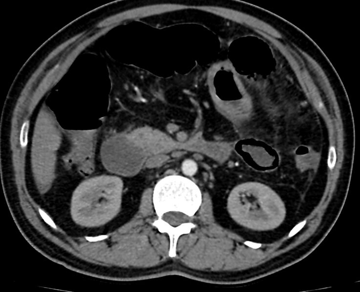 File:Acute mesenteric ischemia - superior mesenteric artery thrombosis (Radiopaedia 73947-84776 Axial C+ arterial phase 42).jpg