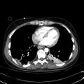 Acute myocardial infarction in CT (Radiopaedia 39947-42415 Axial C+ arterial phase 94).jpg