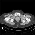 Acute pancreatitis (Radiopaedia 19136-19117 Axial C+ portal venous phase 44).jpg