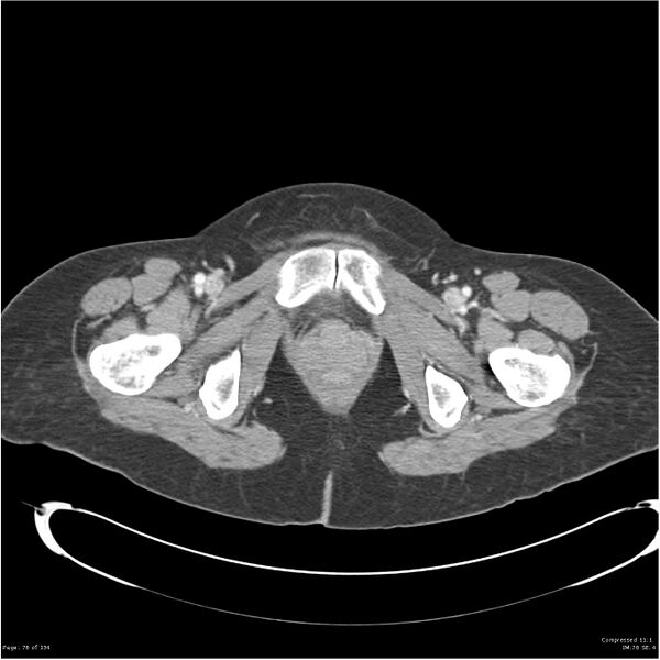 File:Acute pancreatitis (Radiopaedia 19136-19117 Axial C+ portal venous phase 44).jpg
