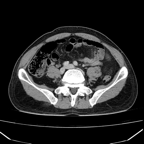 File:Acute pancreatitis (Radiopaedia 22572-22596 Axial C+ portal venous phase 50).jpg