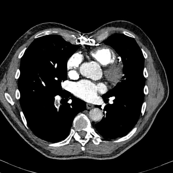 File:Acute pulmonary embolism (Radiopaedia 81677-95570 Axial C+ CTPA 67).jpg