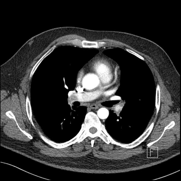 File:Acute pulmonary embolism with pulmonary infarct (Radiopaedia 73062-83768 Axial C+ CTPA 35).jpg