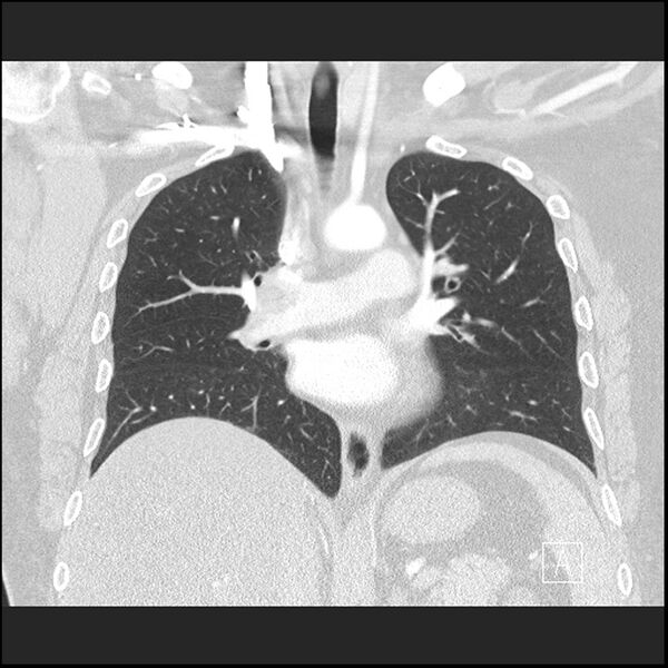 File:Acute pulmonary embolism with pulmonary infarct (Radiopaedia 73062-83768 Coronal lung window 40).jpg