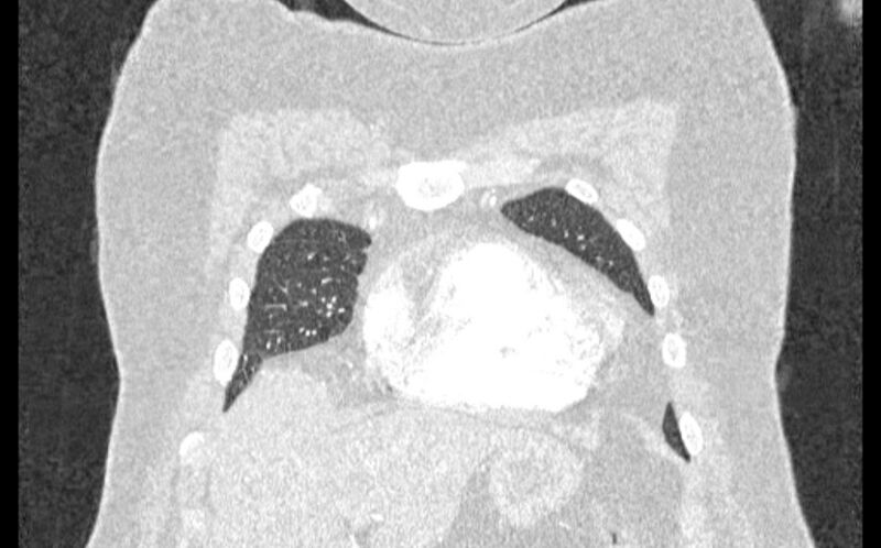 File:Acute pulmonary embolism with pulmonary infarcts (Radiopaedia 77688-89908 Coronal lung window 3).jpg
