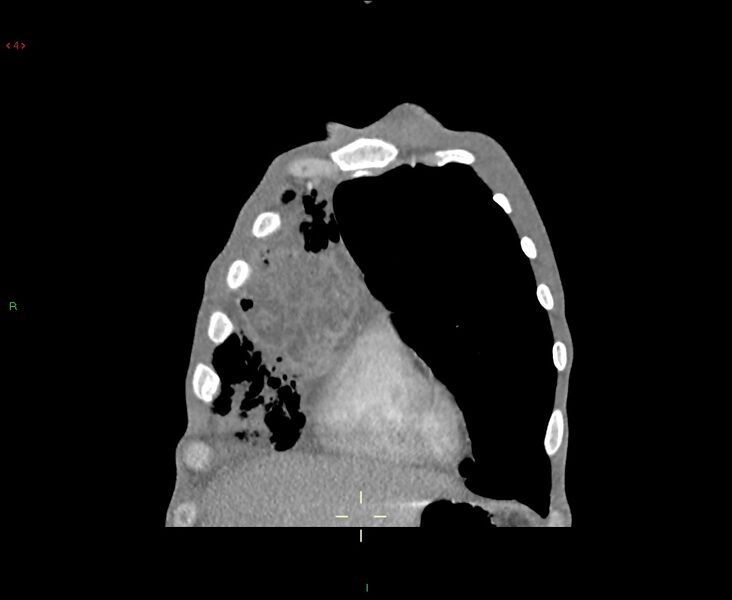 File:Acute right lung abscess (Radiopaedia 34806-36258 Coronal C+ arterial phase 48).jpg