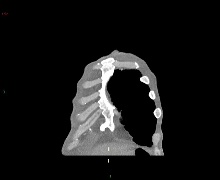 File:Acute right lung abscess (Radiopaedia 34806-36258 Coronal C+ arterial phase 53).jpg