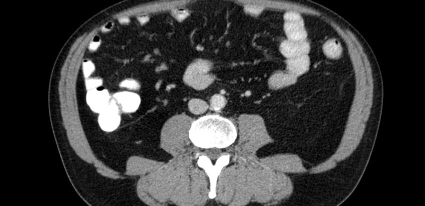 Acute sigmoid colon diverticulitis (Radiopaedia 55507-61976 Axial C+ portal venous phase 31).jpg