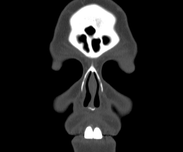 File:Acute sinusitis (Radiopaedia 22419-22455 Coronal bone window 2).jpg