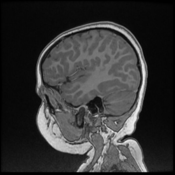 File:Adamantinomatous craniopharyngioma (Radiopaedia 77407-89529 Sagittal T1 C+ 105).jpg