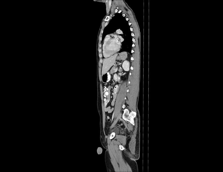 File:Addison disease (Radiopaedia 49318-54412 Sagittal C+ portal venous phase 26).jpg