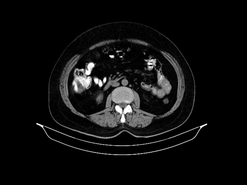 Adenocarcinoma of pancreas with hepatic metastasis (Radiopaedia 64332-73122 Axial non-contrast 53).jpg